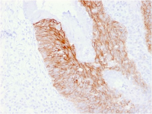 Formalin-fixed, paraffin-embedded human Cervix Carcinoma stained with CD44v6 Mouse Monoclonal Antibody (CD44V6/2496).