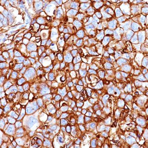 Formalin-fixed, paraffin-embedded human Breast Carcinoma stained with CD44 Mouse Monoclonal Antibody (HCAM/918).
