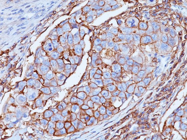 Formalin-fixed, paraffin-embedded human Breast tissue stained with CD44 Mouse Monoclonal Antibody (DF1485).