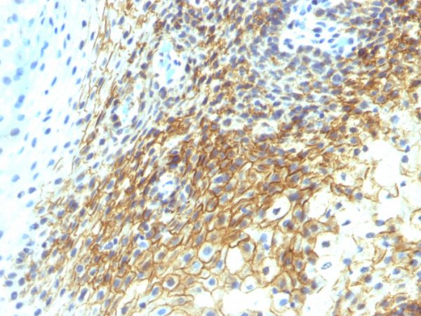 Formalin-fixed, paraffin-embedded human Tongue Squamous Cell Carcinoma stained with CD44v4 Mouse Monoclonal Antibody (CD44v4/1219)