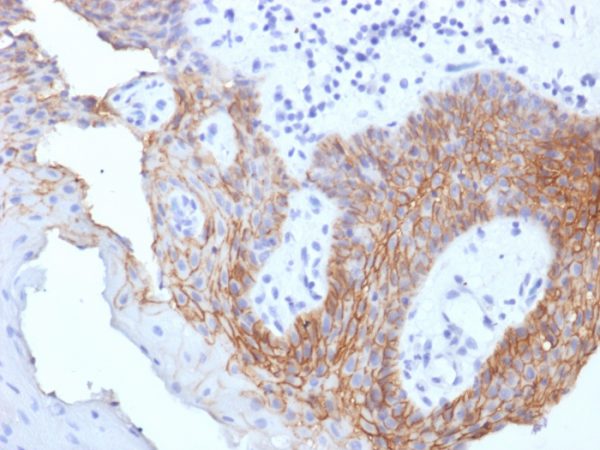 Formalin-fixed, paraffin-embedded human Tongue Carcinoma stained with CD44 Mouse Monoclonal Antibody (CD44v9/1459).