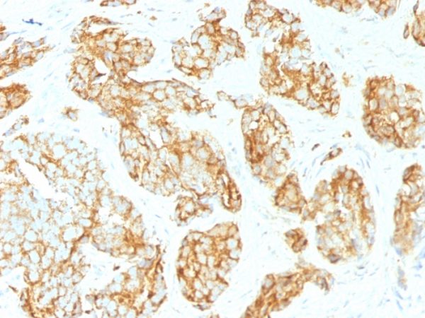 Formalin-fixed, paraffin-embedded human Prostate Carcinoma stained with CD44 Mouse Monoclonal Antibody (CD44v9/1459).