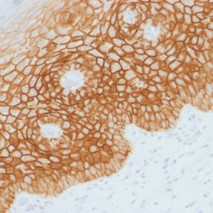 Formalin-fixed, paraffin-embedded human Cervical Squamous Cell Carcinoma stained with CD44v4 Rabbit Polyclonal Antibody.