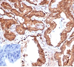 Formalin-fixed, paraffin-embedded human prostate carcinoma stained with CD47 Recombinant Mouse Monoclonal Antibody (rCD47/6365). Inset: PBS instead of primary antibody, secondary control.