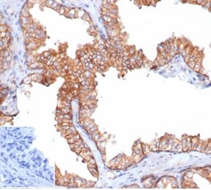 Formalin-fixed, paraffin-embedded human prostate carcinoma stained with CD47 Recombinant Mouse Monoclonal Antibody (rCD47/6589). Inset: PBS instead of primary antibody, secondary control.