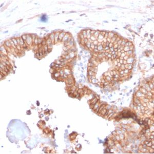 Formalin-fixed, paraffin-embedded human Prostate Carcinoma stained with CD47 Mouse Monoclonal Antibody (IAP/2937).