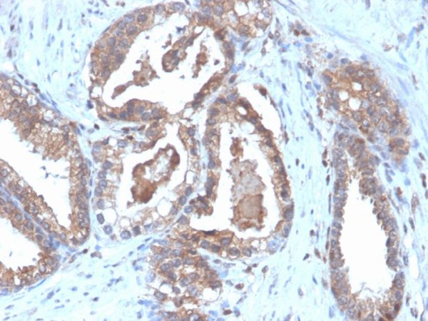 Formalin-fixed, paraffin-embedded human prostate carcinoma stained with CD47 Recombinant Rabbit Monoclonal Antibody (CD47/6364R).