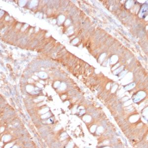 Formalin-fixed, paraffin-embedded human Colon Carcinoma stained with CD59 Rabbit Recombinant Monoclonal Antibody (MACIF/2867R).