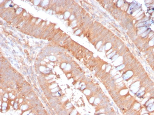 Formalin-fixed, paraffin-embedded human Colon Carcinoma stained with CD59 Rabbit Recombinant Monoclonal Antibody (MACIF/2867R).