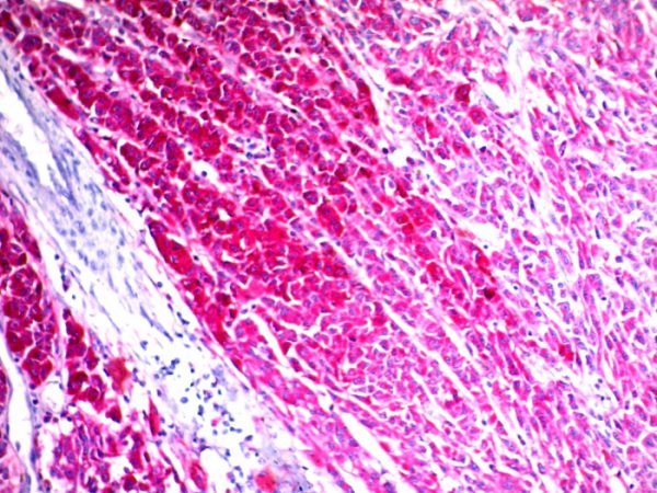 Formalin-fixed, paraffin-embedded human melanoma stained with CD63 Mouse Monoclonal Antibody (NKI/C3) (AEC Chromogen)