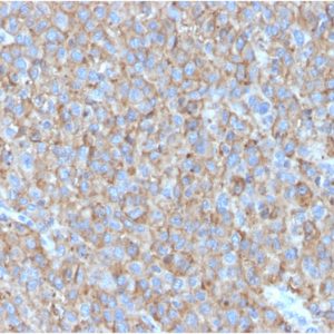 Formalin-fixed, paraffin-embedded human Melanoma stained with CD63 Mouse Monoclonal Antibody (LAMP3/2790).
