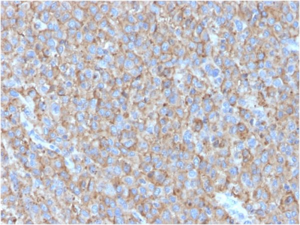 Formalin-fixed, paraffin-embedded human Melanoma stained with CD63 Mouse Monoclonal Antibody (LAMP3/2790).