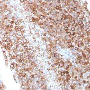 Formalin-fixed, paraffin-embedded human Melanoma stained with CD63 Mouse Monoclonal Antibody (LAMP3/2881)