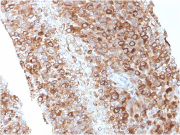 Formalin-fixed, paraffin-embedded human Melanoma stained with CD63 Mouse Monoclonal Antibody (LAMP3/2881)