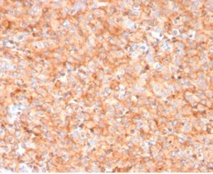 Formalin-fixed, paraffin-embedded human melanoma stained with CD63 Mouse Monoclonal Antibody (LAMP3/3315).