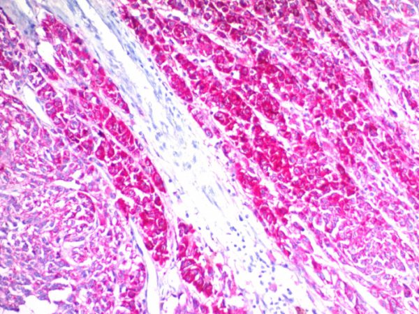 Formalin-fixed, paraffin-embedded human melanoma stained with CD63 Mouse Monoclonal Antibody (SPM524) (AEC chromogen).