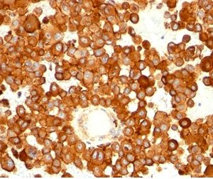 Formalin-fixed, paraffin-embedded human melanoma stained with CD63 Mouse Monoclonal Antibody (MX-49.129.5).