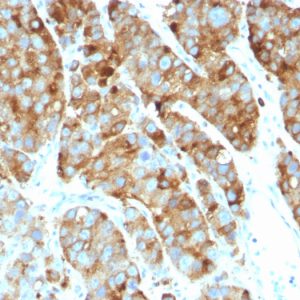 Formalin-fixed, paraffin-embedded human Prostate Carcinoma stained with CD63 Mouse Monoclonal Antibody (LAMP3/968)