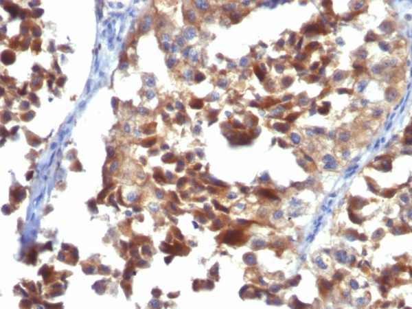 Formalin-fixed, paraffin-embedded human Melanoma stained with CD63 Mouse Monoclonal Antibody (LAMP3/968)