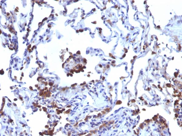 Formalin-fixed, paraffin-embedded human Melanoma metastasized to Lung stained with CD63 Monoclonal Antibody (NKI/C3 + LAMP3/968)