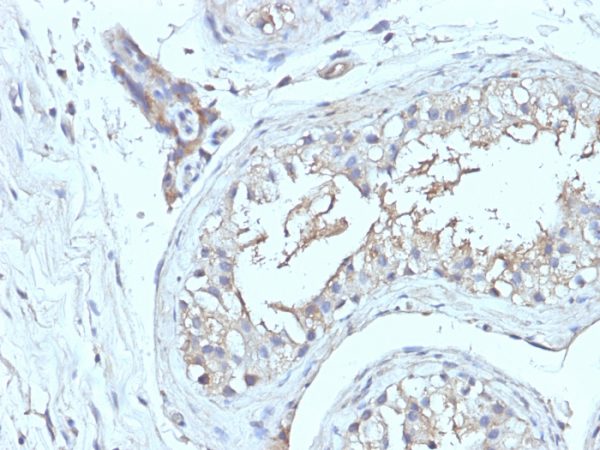 Formalin-fixed, paraffin-embedded human Testicular Ca stained with CD63 Monoclonal Antibody (NKI/C3 + LAMP3/968)