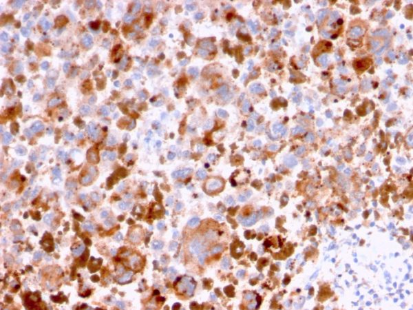 Formalin-fixed, paraffin-embedded human Melanoma stained with CD63 Mouse Monoclonal Antibody (LAMP3/2788).