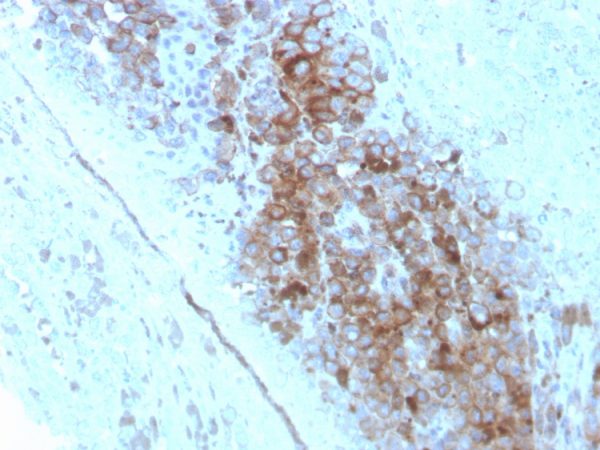 Formalin-fixed, paraffin-embedded human Melanoma stained with CD63 Mouse Monoclonal Antibody (LAMP3/2789).