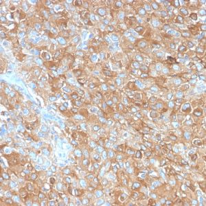 Formalin-fixed, paraffin-embedded human Prostate Carcinoma stained with CD63 Rabbit Recombinant Monoclonal Antibody (LAMP3/2990R).