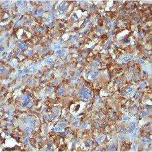 Formalin-fixed, paraffin-embedded human Histiocytoma stained with CD68 Mouse Monoclonal Antibody (C68/684).