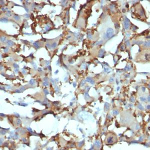 Formalin-fixed, paraffin-embedded human Histiocytoma stained with CD68 Mouse Monoclonal Antibody (KP1+C68/684).