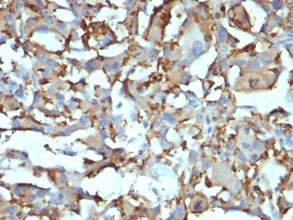 Formalin-fixed, paraffin-embedded human Histiocytoma stained with CD68 Mouse Monoclonal Antibody (KP1+C68/684).