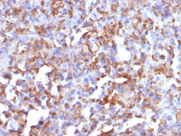 Formalin-fixed, paraffin-embedded human Histiocytoma stained with CD68 Mouse Monoclonal Antibody (LAMP4/824).