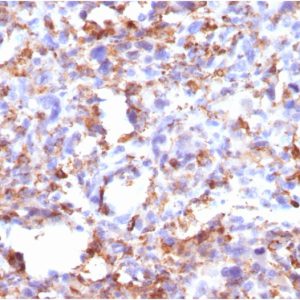 Formalin-fixed, paraffin-embedded human Histiocytoma stained with CD68 Mouse Monoclonal Antibody (CD68/G2).