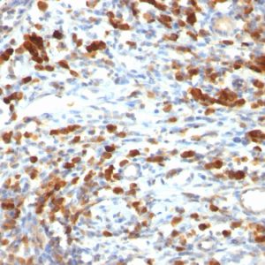 Formalin-fixed, paraffin-embedded human Lymphoma stained with CD79a Mouse Monoclonal Antibody (IGA/764)