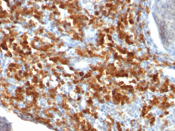 Formalin-fixed, paraffin-embedded human lymphoma stained with CD79a Mouse Monoclonal Antibody (IGA/515).