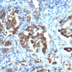 Formalin-fixed, paraffin-embedded human Gastric carcinoma stained with CDC20 Monoclonal Antibody (CDC20/1102)