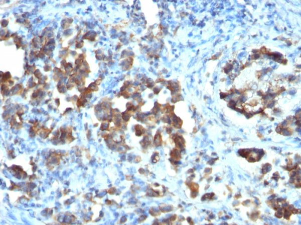 Formalin-fixed, paraffin-embedded human Gastric carcinoma stained with CDC20 Monoclonal Antibody (CDC20/1102)