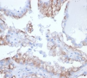 Formalin-fixed, paraffin-embedded human kidney cancer stained with CDC20 Recombinant Mouse Monoclonal Antibody (rCDC20/7184) at 2ug/ml. HIER: Tris/EDTA, pH9.0, 45min. 2°C: HRP-polymer, 30min. DAB, 5min.