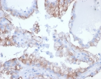 Formalin-fixed, paraffin-embedded human kidney cancer stained with CDC20 Recombinant Mouse Monoclonal Antibody (rCDC20/7184) at 2ug/ml. HIER: Tris/EDTA, pH9.0, 45min. 2 °: HRP-polymer, 30min. DAB, 5min.