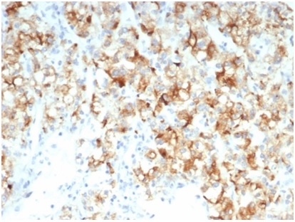 Formalin-fixed, paraffin-embedded human kidney carcinomastained with CDC20 Recombinant Rabbit Monoclonal Antibody (CDC20/7026R) at 2ug/ml. HIER: Tris/EDTA, pH9.0, 45min. 2 °: HRP-polymer, 30min. DAB, 5min.
