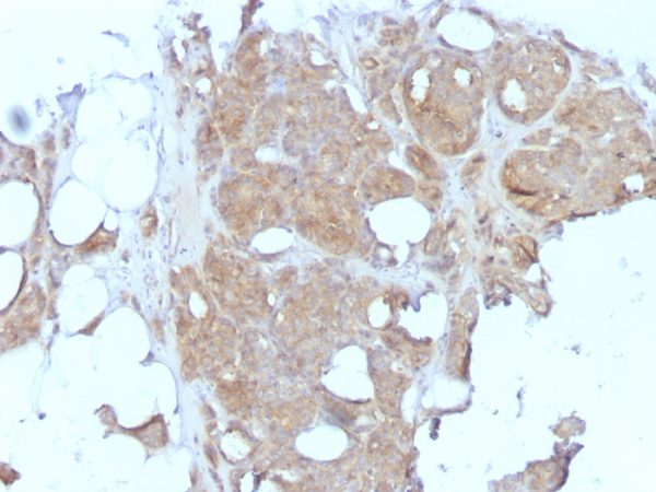 Formalin-fixed, paraffin-embedded human Breast Carcinoma stained with MVP Monoclonal Antibody (1032).