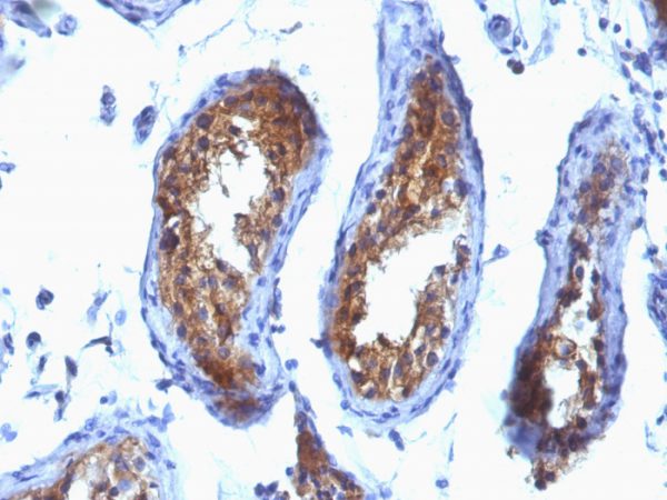Formalin-fixed, paraffin-embedded human Testicular Carcinoma stained with MVP Monoclonal Antibody (SPM280).