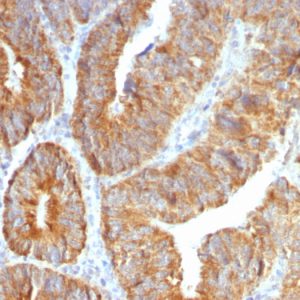 Formalin-fixed, paraffin-embedded human Colon Carcinoma stained with TNFS15 / VEGI Monoclonal Antibody (VEGI /1283).