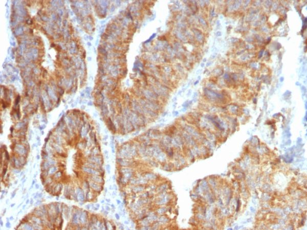 Formalin-fixed, paraffin-embedded human Colon Carcinoma stained with TNFS15 / VEGI Monoclonal Antibody (VEGI /1283).