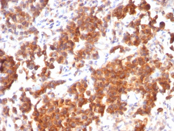 Formalin-fixed, paraffin-embedded human Parathyroid Mass stained with VEGI Mouse Recombinant Monoclonal Antibody (rVEGI /1283).