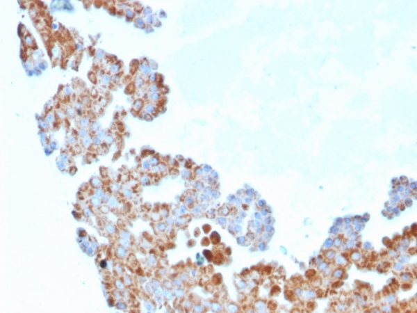 Formalin-fixed, paraffin-embedded human Breast Carcinoma stained with CDC34 Mouse Monoclonal Antibody (CPTC-CDC34-2).