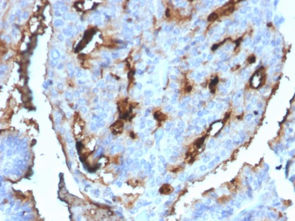 Formalin-fixed, paraffin-embedded human Breast Carcinoma stained with CDC34 Mouse Monoclonal Antibody (CPTC-CDC34-2).