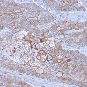 Formalin-fixed, paraffin-embedded human Breast Carcinoma stained with E-Cadherin Mouse Monoclonal Antibody (CDH1/3256).