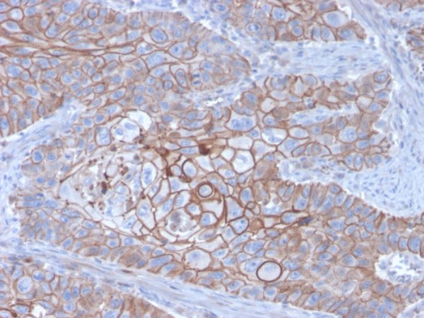 Formalin-fixed, paraffin-embedded human Breast Carcinoma stained with E-Cadherin Mouse Monoclonal Antibody (CDH1/3256).