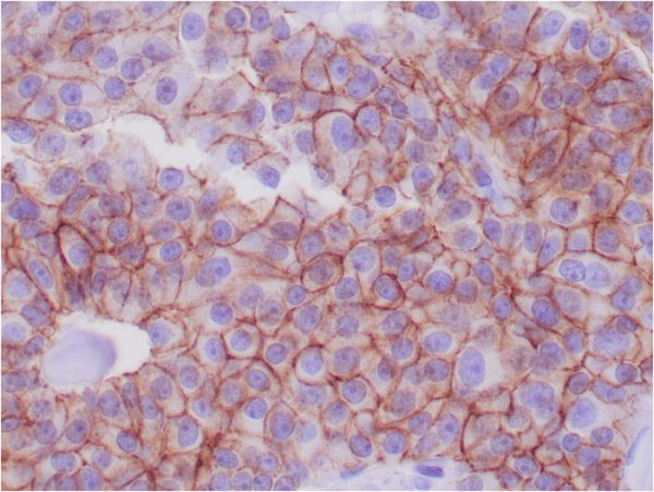 Formalin-fixed, paraffin-embedded human breast adenocarcinoma stained with E-Cadherin Mouse Monoclonal Antibody (CDH1/1525).